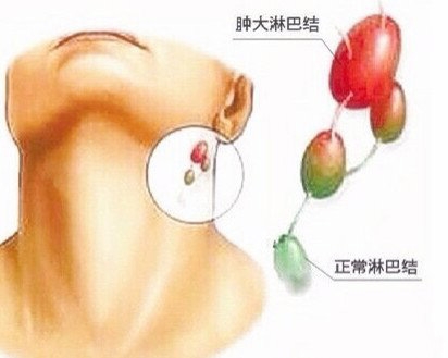 注意了!脖子上长小肉粒是怎么回事? LIFE生活