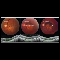 幹細胞植入視網膜 重現光明又沒生出腫瘤 | 健康達人網