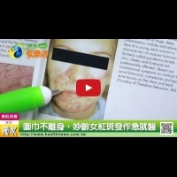 圍巾不離身 妙齡女紅斑發作急就醫