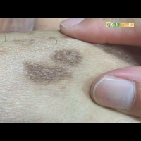 凝膠擦傷口保護一時卻可能留黑疤