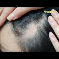 八仙塵暴火燒毛髮　醫：疤痕植髮需觀察1年