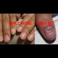 指甲上有凹陷是什麼原因??