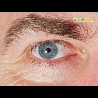 銀髮族眼睛模糊　玻璃體黃斑部牽引導致
