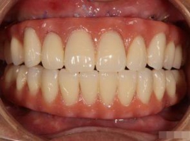 全口無牙治療新技術　5天內可正常進食