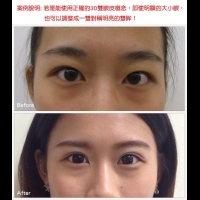 顛覆傳統雙眼皮手術的　3D雙眼皮成形手術