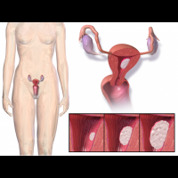 子宮頸癌知多少-性經驗早易罹患?