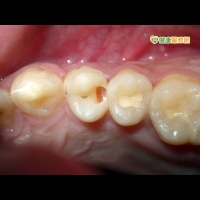 女罹下陷型齲齒　牙齒敏感痠痛竟全蛀空