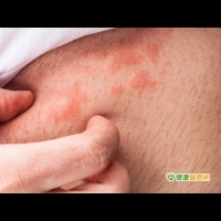 蚊蟲叮咬皮膚炎　嚴重恐過敏性休克