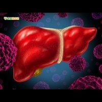 B肝患者屬肝癌高危險群　應每半年檢查