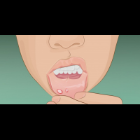嘴巴破洞好痛怎麼辦？8個簡單方法讓你一天就痊癒！