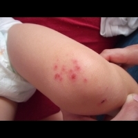 露出肌膚的季節～避免孩子因為植物而「過敏・起疹子」的方法是什麼？