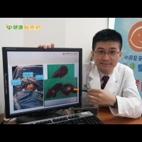 台灣兒童外科創新頁　8月嬰完成腹腔鏡腫瘤切除