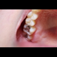 國際組織支持全球禁用牙科汞合金行動