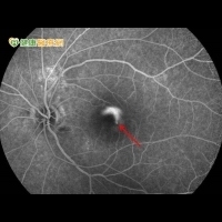 單眼視力突下降　光動力療法縮短病程