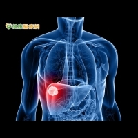 肝動脈導管納健保　肝癌患者省2萬4！