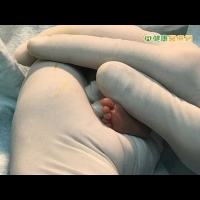破紀錄！　478克早產兒動脈導管手術成功