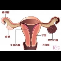 子宮內膜異位 朱古力瘤 影響受孕機會？