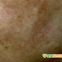 過度雷射　除痘疤反致皮膚發炎變黑