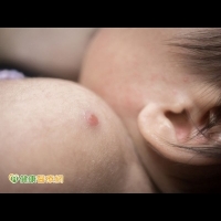 嬰幼兒接種卡介苗　膿瘍三個月未消速就醫