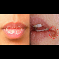 嘴唇「乾裂脫皮」、口角炎不是因為缺水，別再猛塗護唇膏！補充「4種營養素」才能治標又治本！