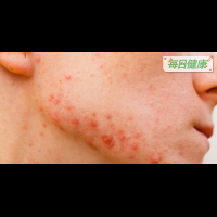 臉上「紅斑」不是過敏，而是「螨蟲」寄生正在搾取皮膚油脂！一秒看懂「除蟲洗臉法」｜每日健康 Health