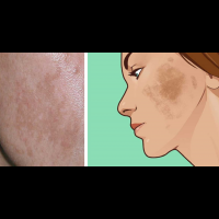 你也有令人討厭的「黃褐斑」嗎？6個天然方法改善皮膚變色，戰勝「媽媽臉」！