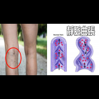 稍微久站「靜脈曲張」馬上現形？簡易、天然的按摩療法，消除血管腫脹恢復美腿。