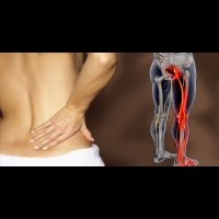 「背痛」並不一定等於「坐骨神經痛」！5招簡單判別法，避免錯過黃金治療期！