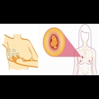 穿胸罩容易提高「乳癌」發生率？ 預防「乳癌」上門，這四件事妳不可不知。
