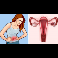 「卵巢囊腫」其實很多女性都有！這些警訊必須注意，否則卵巢毀了，下半生也毀了。