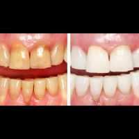 一口「黃牙」讓你不敢露齒笑？醫美博士揭開7個「居家美白牙齒法」，牙垢、角質灰飛煙滅免花錢！