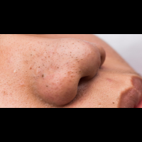 千萬不能偷懶每天的護膚很重要☆讓肌膚看上去髒髒的「草莓鼻」形成原因及根治方法♪