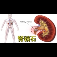 台灣「腎結石」盛行，9種蔬菜「這樣吃」把腎臟清乾淨，改善結石，從此不當石頭一族。