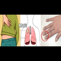 背痛、指甲彎曲恐是「肺癌」前兆：「8大症狀」早期發現，存活率飆升！｜每日健康Health