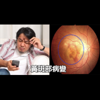 「黃斑部病變」是失明最大元兇，三大高風險族群必吃的「護眼食物」｜每日健康 Health