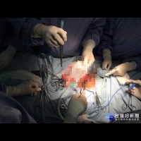疝氣手術新紀元　經皮修補免用腹腔鏡