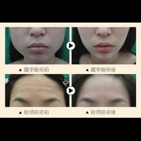 微整第一課“抗初老” 肉毒全臉微雕