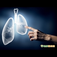 肺癌早期症狀不明顯　低劑量電腦斷層揪病灶