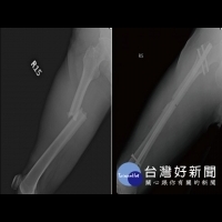 來台車禍重傷逐漸恢復　新加坡民眾：台灣醫療水準高