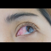 近視多於600度，小心引起眼睛「這種疾病」，甚至導致失明...