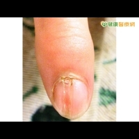 指甲凹陷變形　竟是甲床下球狀瘤惹禍