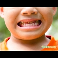 防兒童蛀牙　這七大重點記下來
