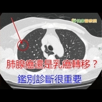 肺腺癌還是乳癌轉移？　鑑別診斷很重要