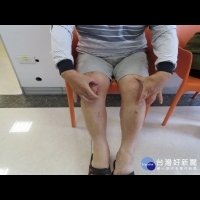 男子常搬重物造成膝蓋受損　機器人手臂關節手術後恢復快