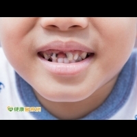 六歲兒童蛀牙率近八成　塗氟增加保護力