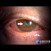 用眼過度竟罹乾眼症　工程師靠「自體血清眼藥水」挽救視力