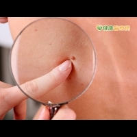 防治皮膚癌　發現這四徵兆速就醫