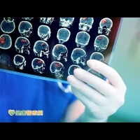 腦瘤免開腦！？　加馬刀手術破壞腫瘤DNA