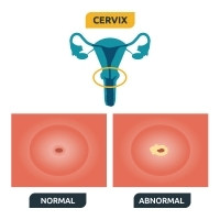 女性感染HPV病毒 與子宮頸癌罹患風險呈正相關