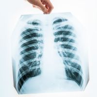 胸部X光篩檢發現肺部結節 一定是癌症嗎？